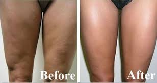 gambe cellulite eliminare la cellulite